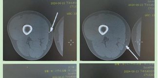 Попытка удалить металлические осколки подшипника с помощью магнита закончилась неудачей